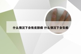 什么情况下会有皮肤癣 什么情况下会生癣