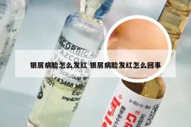 银屑病脸怎么发红 银屑病脸发红怎么回事