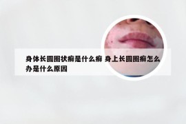 身体长圆圈状癣是什么癣 身上长圆圈癣怎么办是什么原因