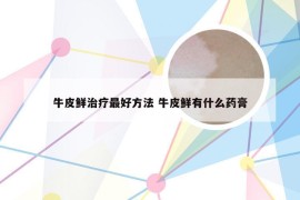 牛皮鲜治疗最好方法 牛皮鲜有什么药膏