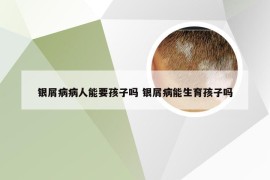 银屑病病人能要孩子吗 银屑病能生育孩子吗