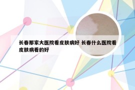 长春那家大医院看皮肤病好 长春什么医院看皮肤病看的好