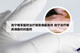 南宁哪家医院治疗银屑病最有效 南宁治疗银屑病最好的医院