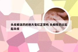 头皮癣涂药的地方变红正常吗 头癣擦药以后起白皮