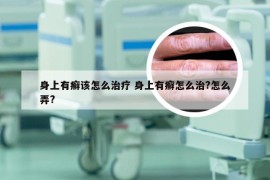 身上有癣该怎么治疗 身上有癣怎么治?怎么弄?