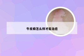 牛皮癣怎么样才能治愈