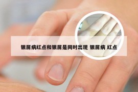 银屑病红点和银屑是同时出现 银屑病 红点