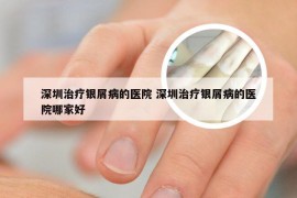 深圳治疗银屑病的医院 深圳治疗银屑病的医院哪家好