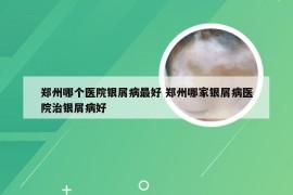 郑州哪个医院银屑病最好 郑州哪家银屑病医院治银屑病好