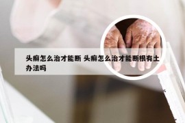 头癣怎么治才能断 头癣怎么治才能断根有土办法吗