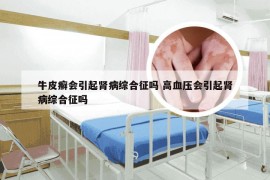 牛皮癣会引起肾病综合征吗 高血压会引起肾病综合征吗