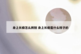 身上长癣怎么辨别 身上长癣是什么样子的