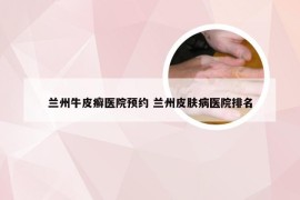 兰州牛皮癣医院预约 兰州皮肤病医院排名