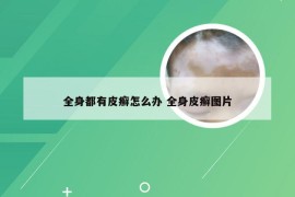 全身都有皮癣怎么办 全身皮癣图片