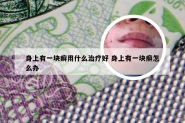 身上有一块癣用什么治疗好 身上有一块癣怎么办