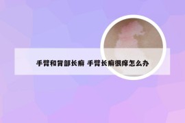 手臂和背部长癣 手臂长癣很痒怎么办