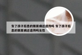 生了孩子后患的银屑病还遗传吗 生了孩子后患的银屑病还遗传吗女性