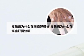 皮肤病为什么在海南好得快 皮肤病为什么在海南好得快呢