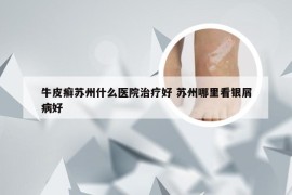 牛皮癣苏州什么医院治疗好 苏州哪里看银屑病好