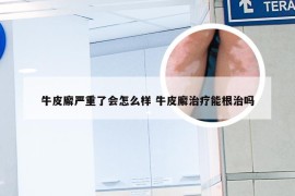 牛皮廨严重了会怎么样 牛皮廨治疗能根治吗