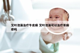 艾叶泡澡治疗牛皮癣 艾叶泡澡可以治疗荨麻疹吗