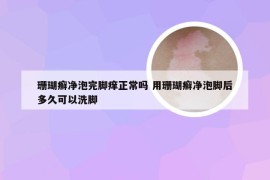 珊瑚癣净泡完脚痒正常吗 用珊瑚癣净泡脚后多久可以洗脚