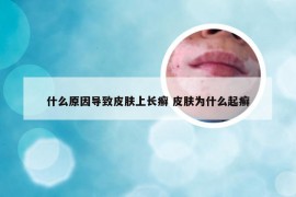 什么原因导致皮肤上长癣 皮肤为什么起癣