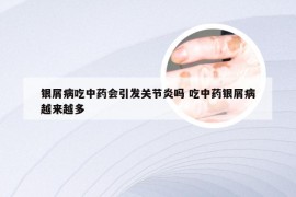 银屑病吃中药会引发关节炎吗 吃中药银屑病越来越多