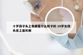 十岁孩子头上有癣是什么样子的 10岁女孩头皮上面长癣