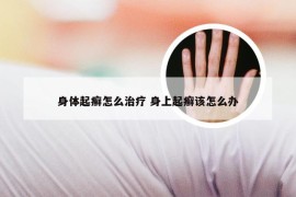 身体起癣怎么治疗 身上起癣该怎么办