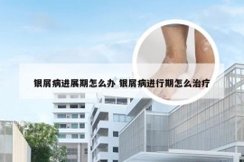 银屑病进展期怎么办 银屑病进行期怎么治疗