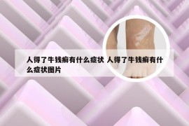 人得了牛钱癣有什么症状 人得了牛钱癣有什么症状图片