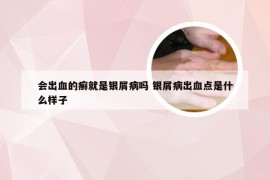 会出血的癣就是银屑病吗 银屑病出血点是什么样子