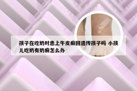 孩子在吃奶时患上牛皮癣回遗传孩子吗 小孩儿吃奶有奶癣怎么办