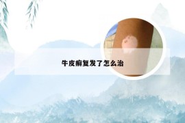 牛皮癣复发了怎么治