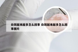 白斑越来越多怎么回事 白斑越来越多怎么回事图片