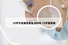 15岁牛皮癣患者能治好吗 15岁银屑病