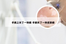 手腕上长了一块癣 手腕长了一块皮肤癣