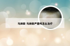 马蹄藓 马蹄藓严重吗怎么治疗