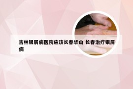 吉林银屑病医院应该长春华山 长春治疗银屑病