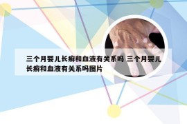 三个月婴儿长癣和血液有关系吗 三个月婴儿长癣和血液有关系吗图片