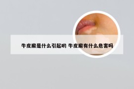 牛皮廨是什么引起哟 牛皮廨有什么危害吗