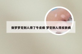 做梦梦见别人得了牛皮癣 梦见别人得皮肤病