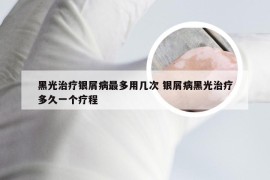 黑光治疗银屑病最多用几次 银屑病黑光治疗多久一个疗程