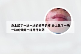 身上起了一块一块的癣干的疼 身上起了一块一块的像癣一样用什么药