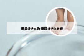 银屑病活血治 银屑病活血化瘀