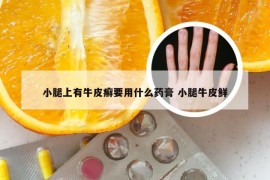 小腿上有牛皮癣要用什么药膏 小腿牛皮鲜