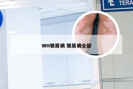 WH银屑病 银屑病全部