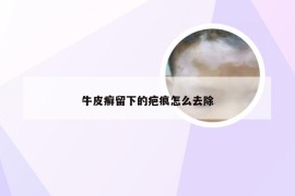 牛皮癣留下的疤痕怎么去除