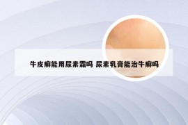 牛皮癣能用尿素霜吗 尿素乳膏能治牛癣吗